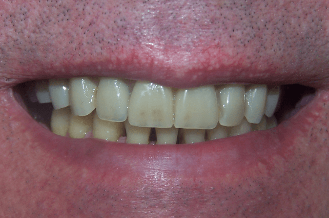 After - All on 4 Kent Dental