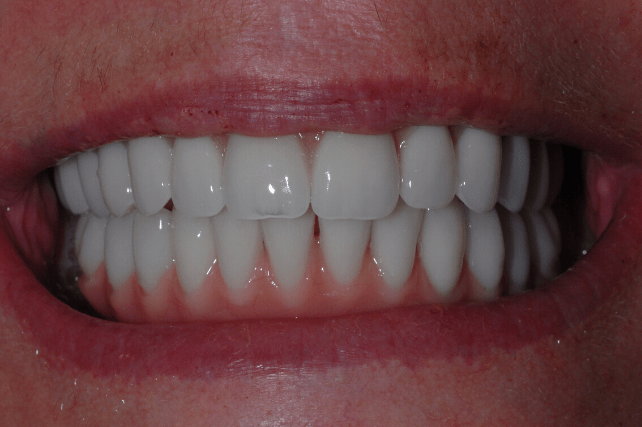 After - All on 4 Kent Dental