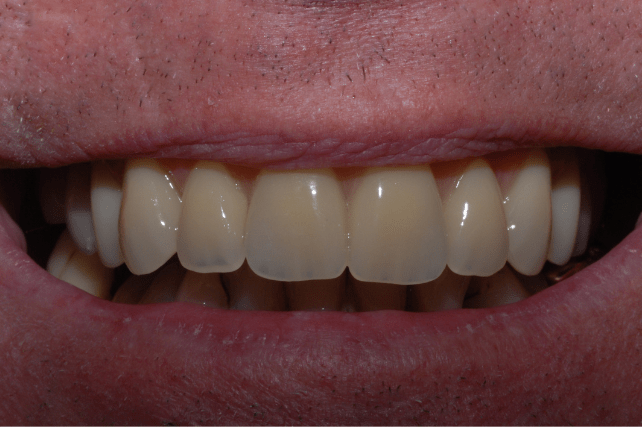 After - All on 4 Kent Dental