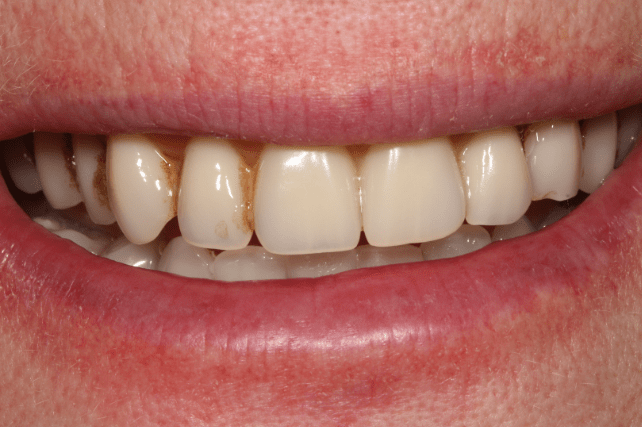 After - All on 4 Kent Dental