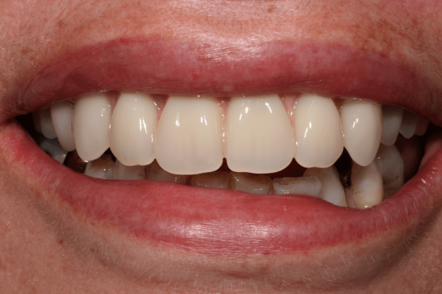 After - All on 4 Kent Dental