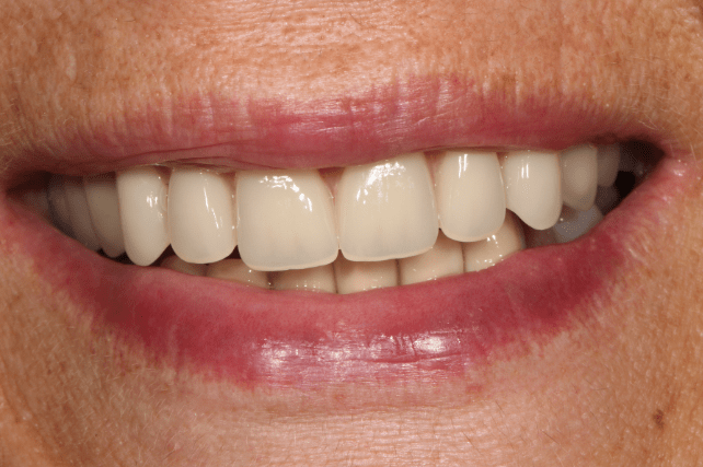 After - All on 4 Kent Dental