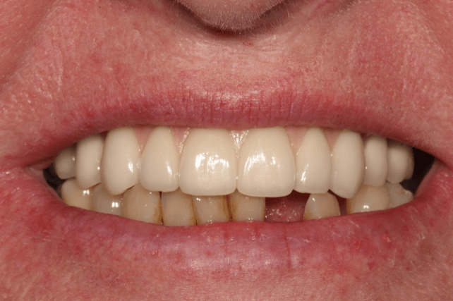 After - All on 4 Kent Dental