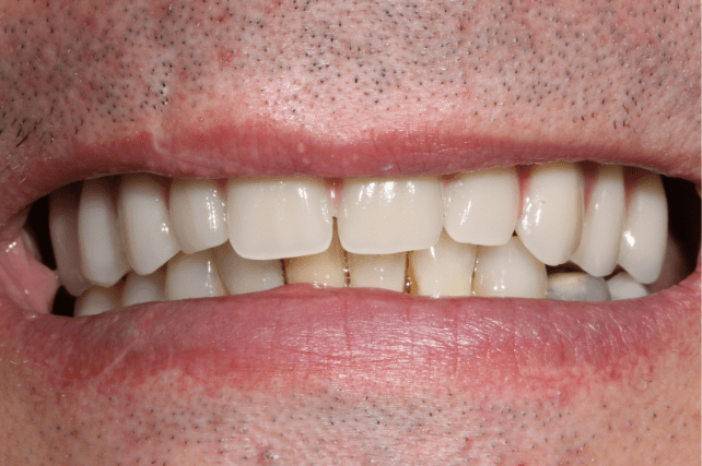 After - All on 4 Kent Dental