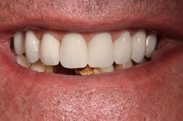 After - All on 4 Kent Dental