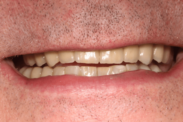 After - All on 4 Kent Dental