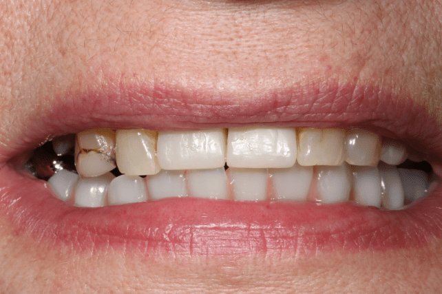 After - All on 4 Kent Dental