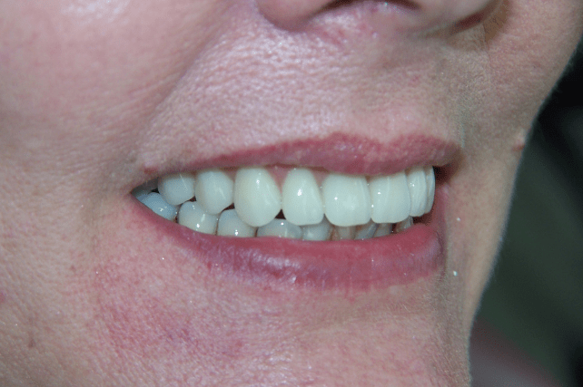 After - All on 4 Kent Dental