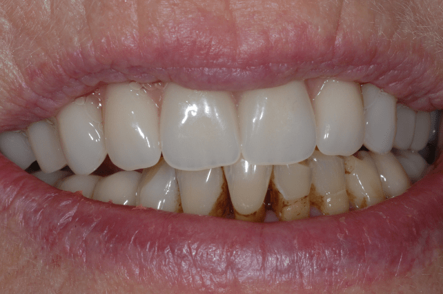 After - All on 4 Kent Dental