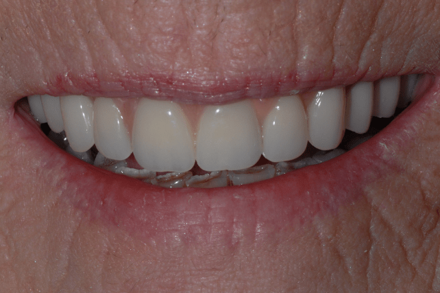After - All on 4 Kent Dental