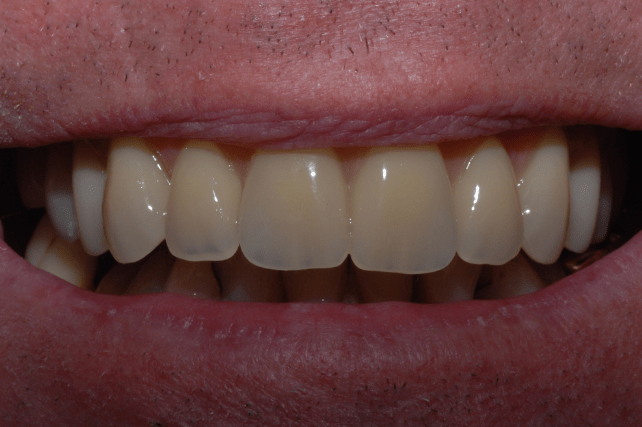 After - All on 4 Kent Dental