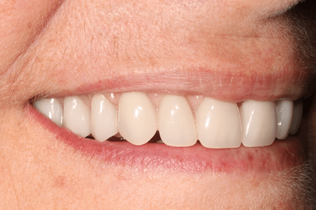 After - All on 4 Kent Dental