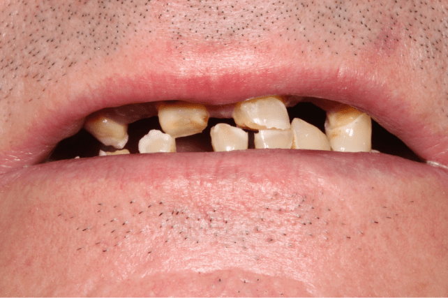 Before - All on 4 Kent Dental