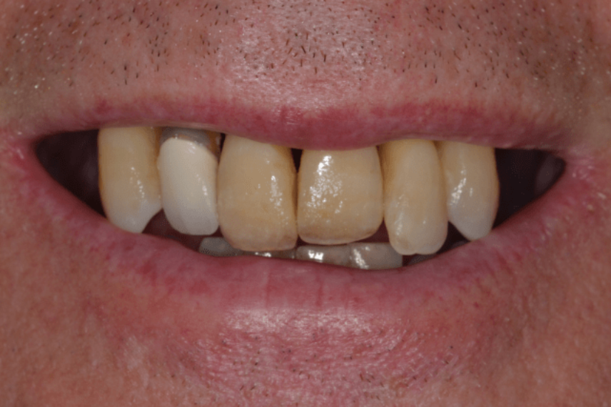 Before - All on 4 Kent Dental