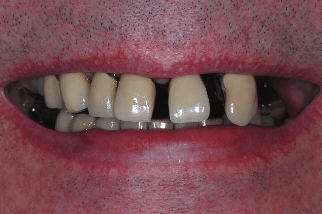 Before - All on 4 Kent Dental