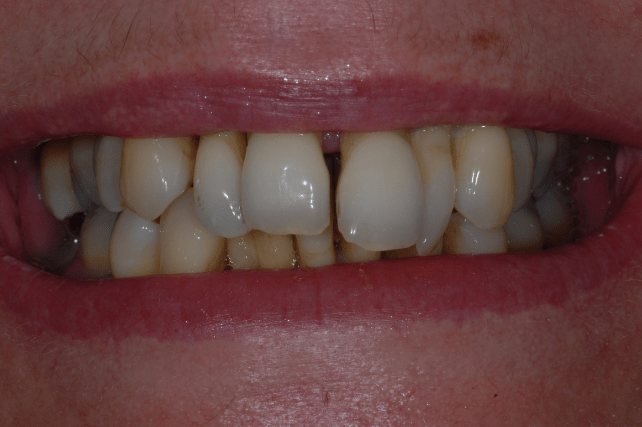 Before - All on 4 Kent Dental