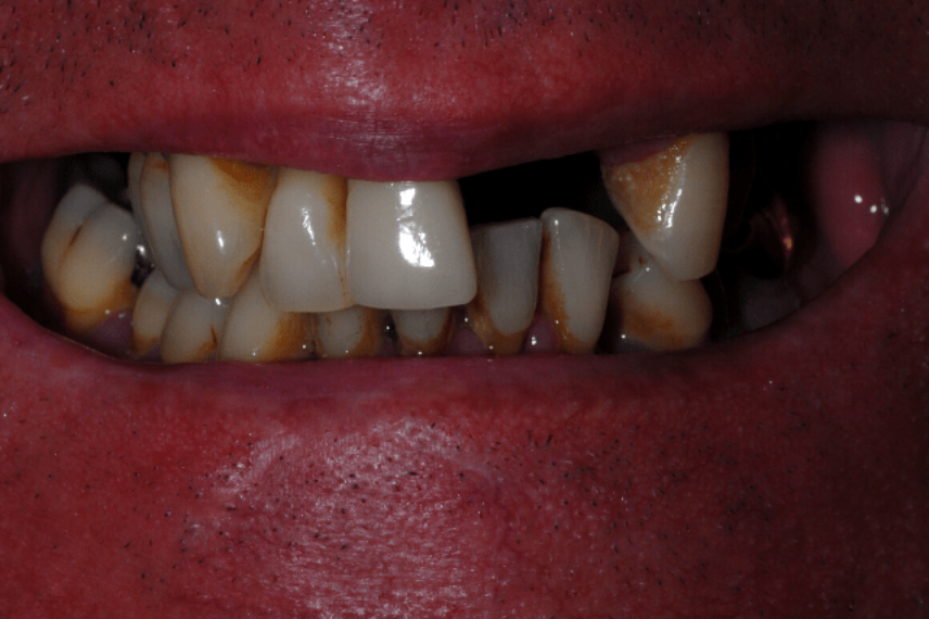 Before - All on 4 Kent Dental