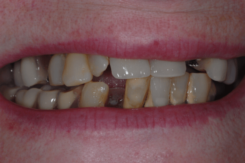 Before - All on 4 Kent Dental