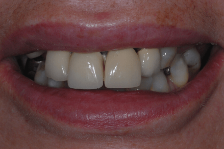 Before - All on 4 Kent Dental