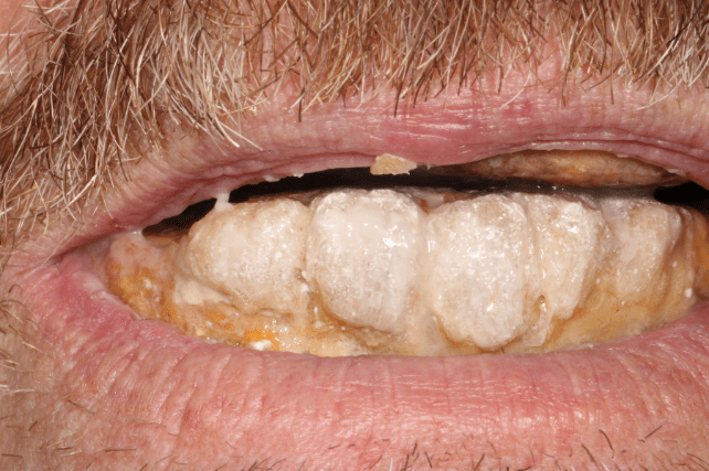 Before - All on 4 Kent Dental
