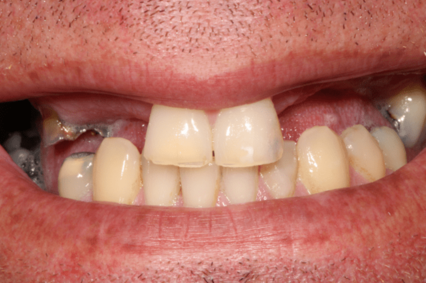 Before - All on 4 Kent Dental