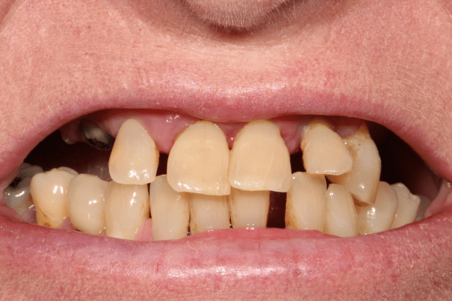 Before - All on 4 Kent Dental