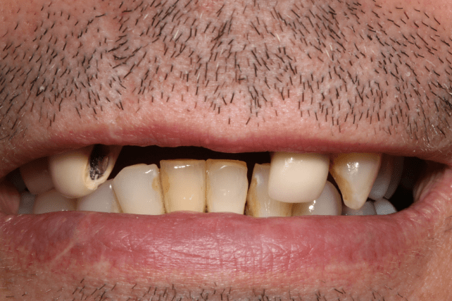 Before - All on 4 Kent Dental