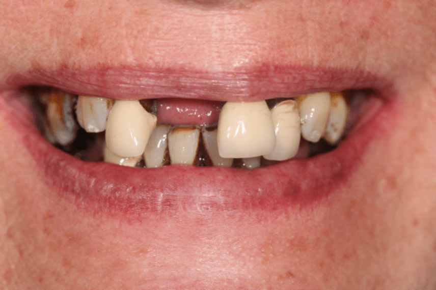 Before - All on 4 Kent Dental