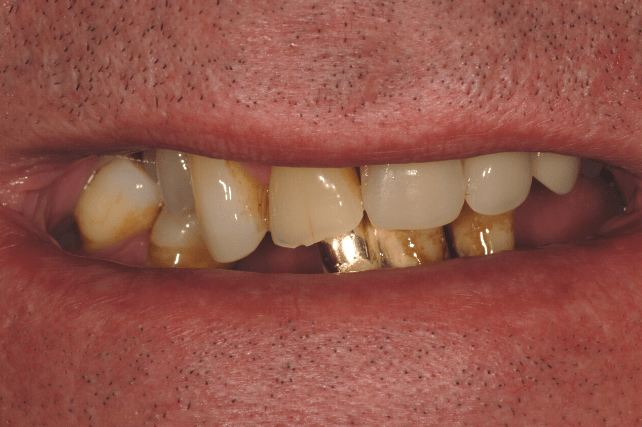 Before - All on 4 Kent Dental