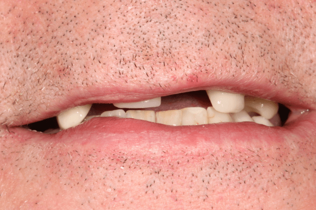 Before - All on 4 Kent Dental