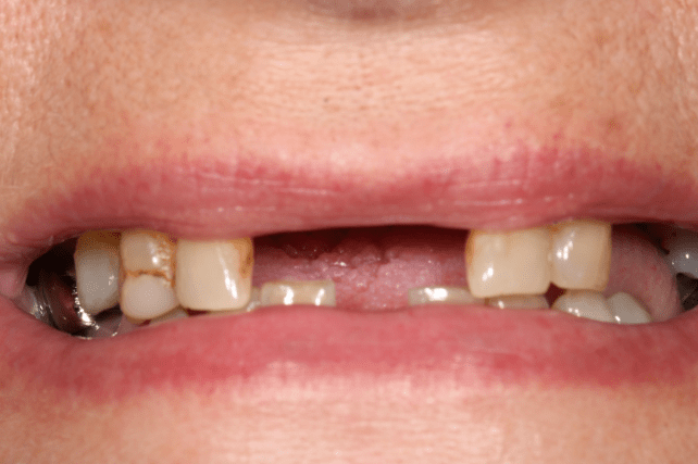 Before - All on 4 Kent Dental