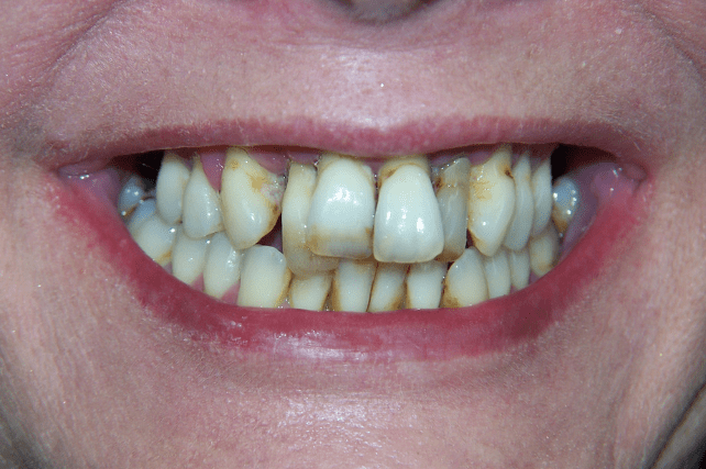 Before - All on 4 Kent Dental