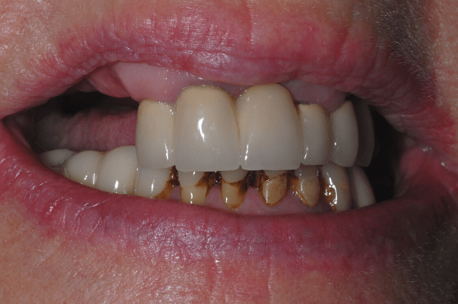 Before - All on 4 Kent Dental