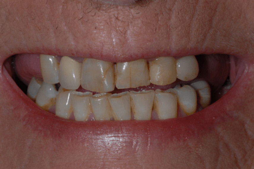 Before - All on 4 Kent Dental