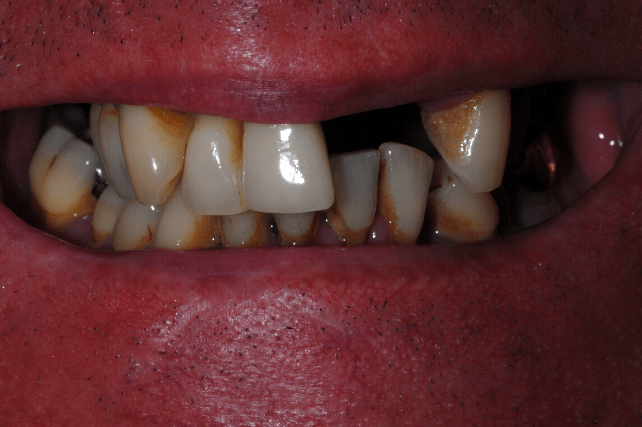 Before - All on 4 Kent Dental