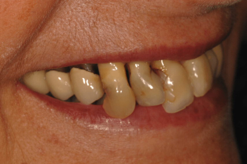 Before - All on 4 Kent Dental