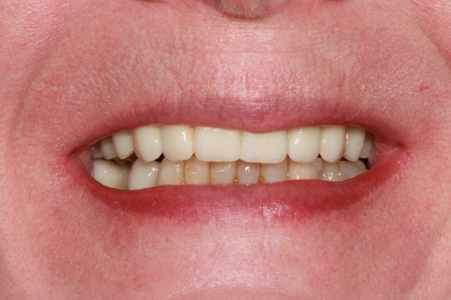 After - All on 4 Kent Dental