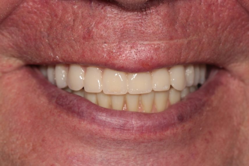 After - All on 4 Kent Dental