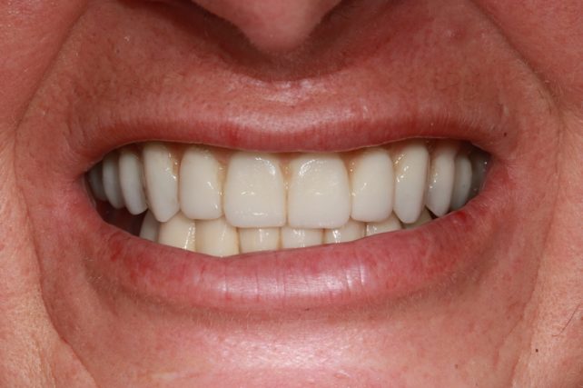 After - All on 4 Kent Dental