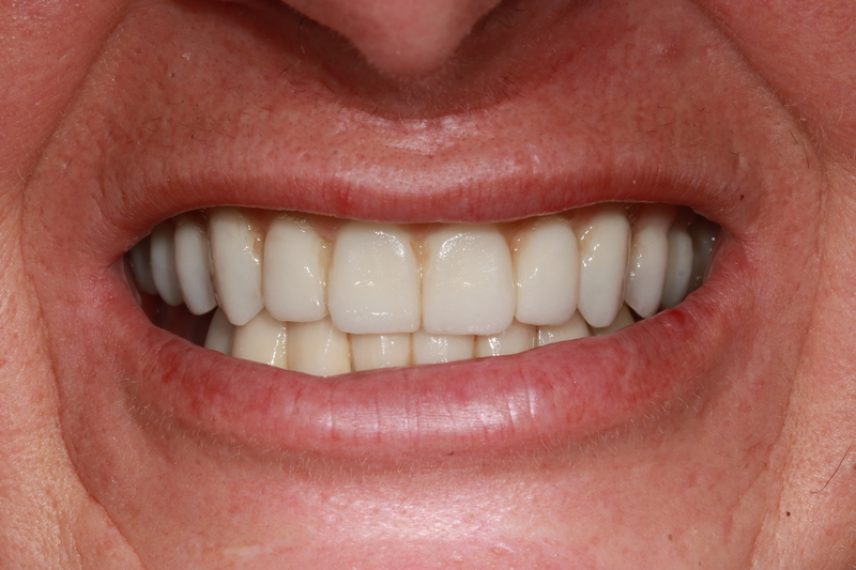 After - All on 4 Kent Dental