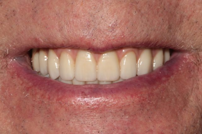 After - All on 4 Kent Dental