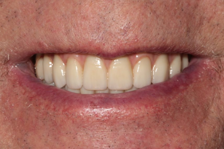 After - All on 4 Kent Dental