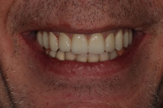 After - All on 4 Kent Dental