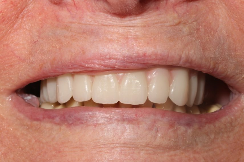 After - All on 4 Kent Dental