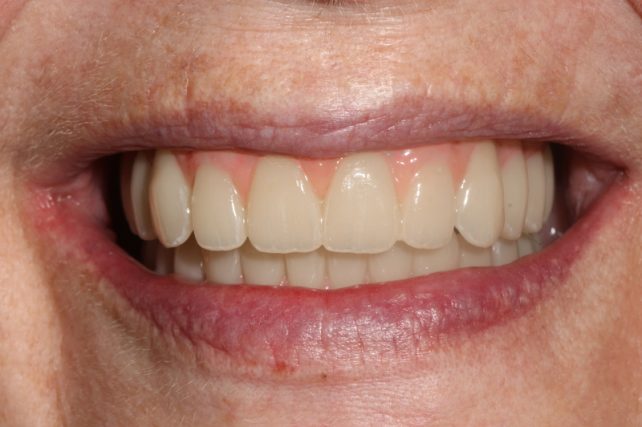 After - All on 4 Kent Dental