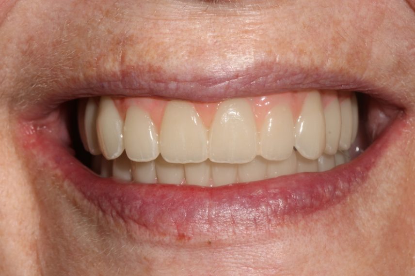 After - All on 4 Kent Dental