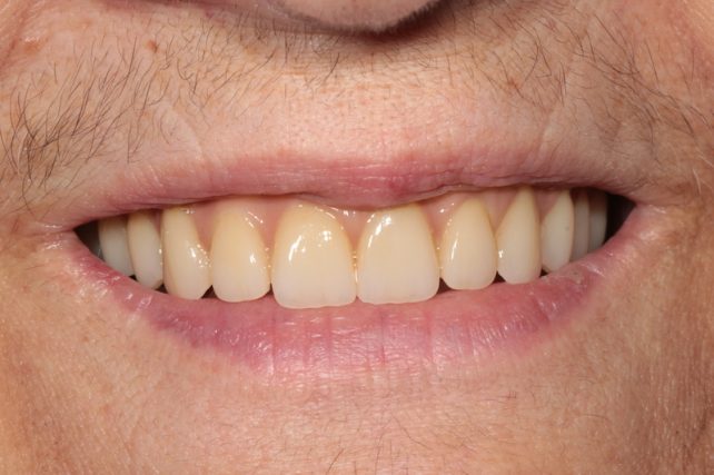 After - All on 4 Kent Dental