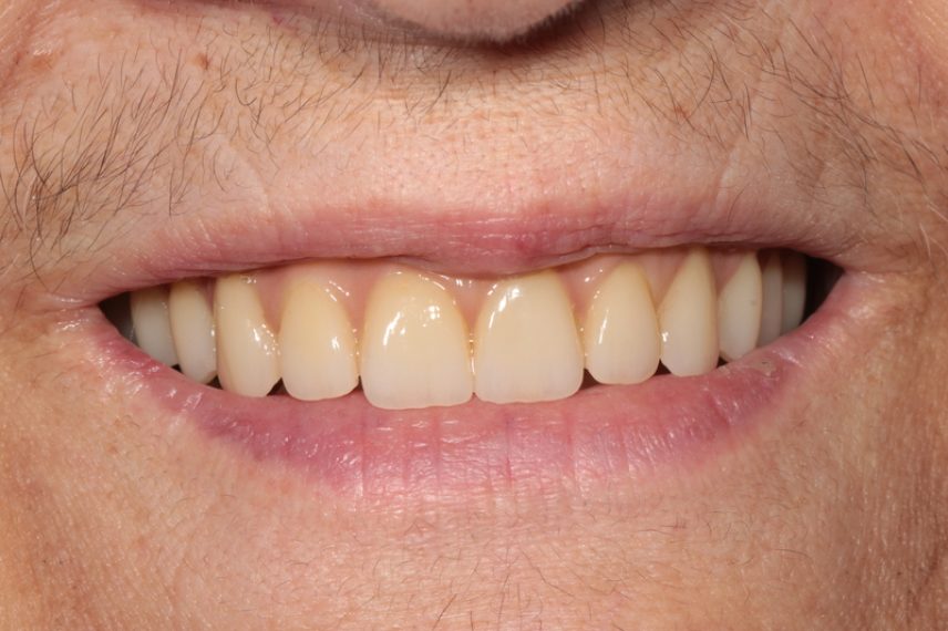 After - All on 4 Kent Dental