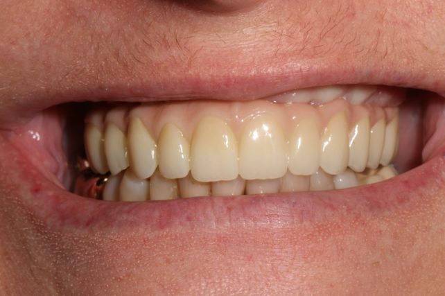 After - All on 4 Kent Dental