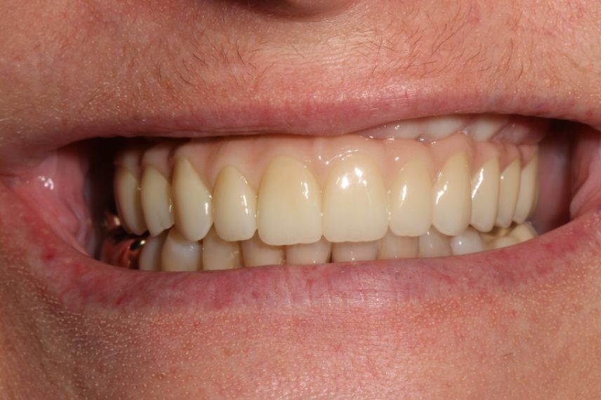 After - All on 4 Kent Dental